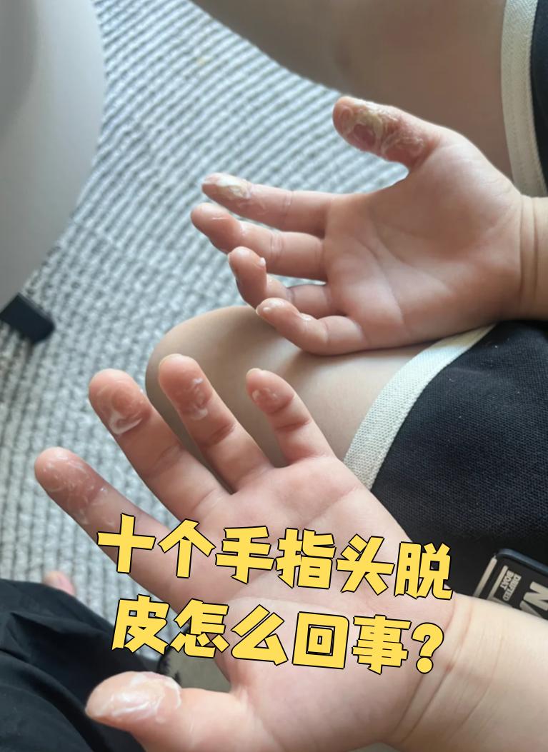 手指肚脱皮怎么回事?