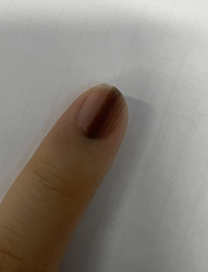 指甲前面有黑线,像刺一样
