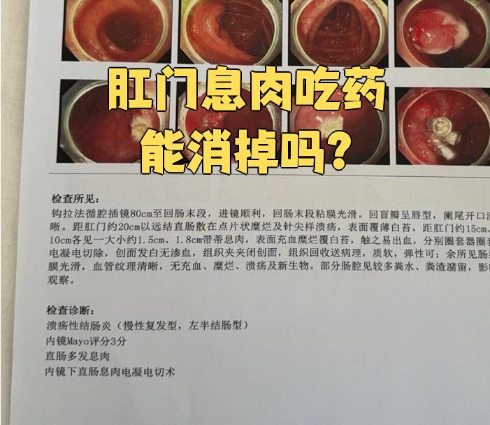 肛门息肉症状是什么?