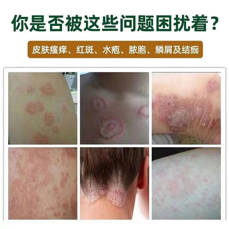 银屑病怎么治疗最快
