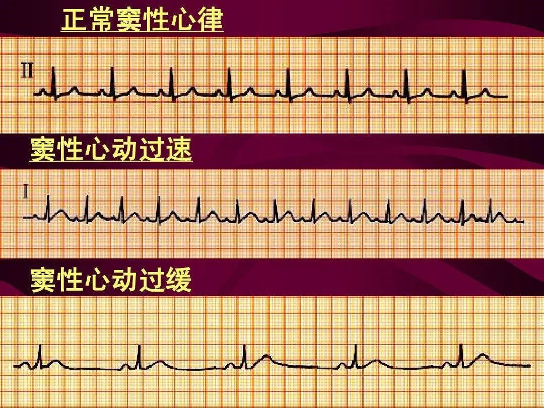窦性心动过缓是什么意思