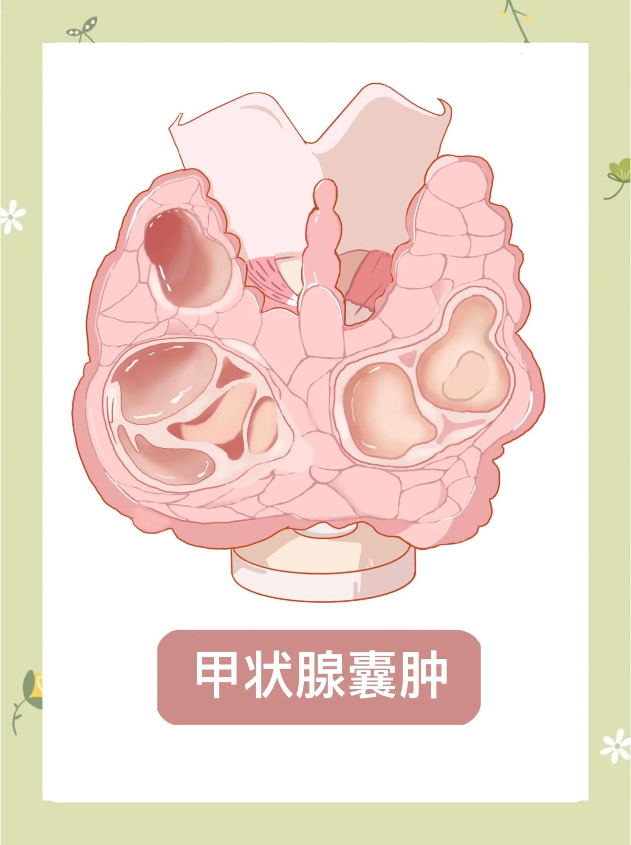 甲状腺囊肿能自己好吗?