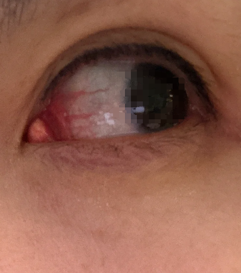眼角突然长了一个肉疙瘩
