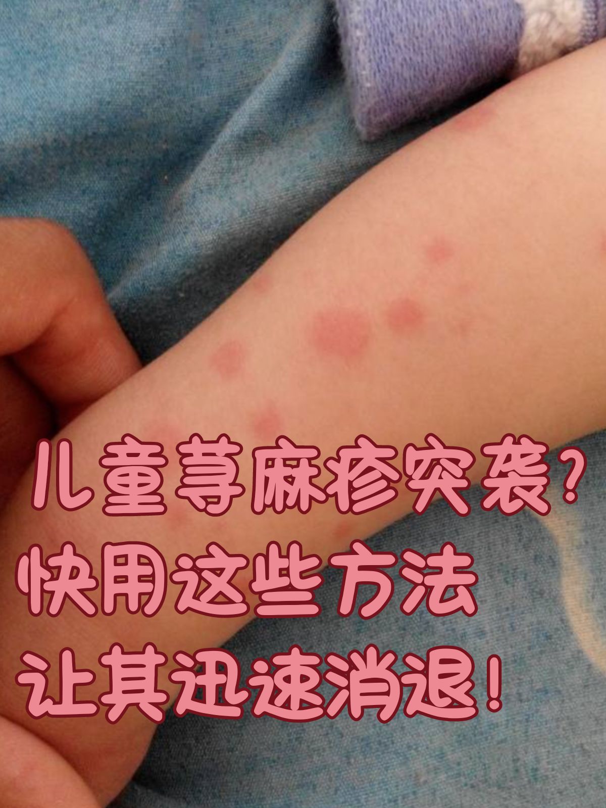 荨麻疹怎样快速止痒
