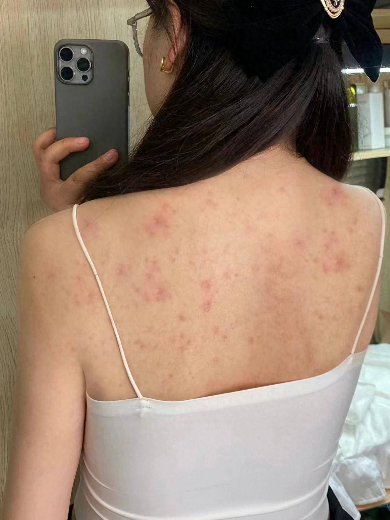 背上长痘痘怎么办