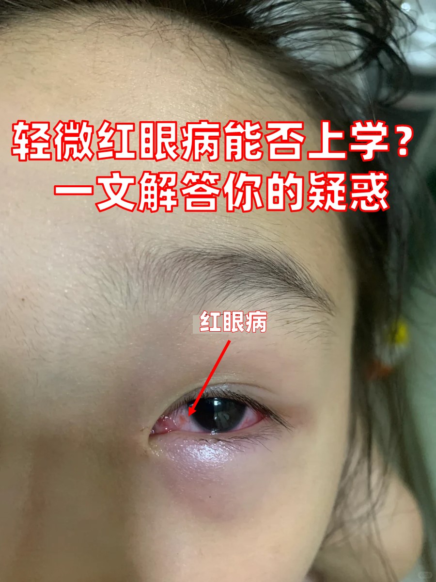 红眼病怎么治疗比较快