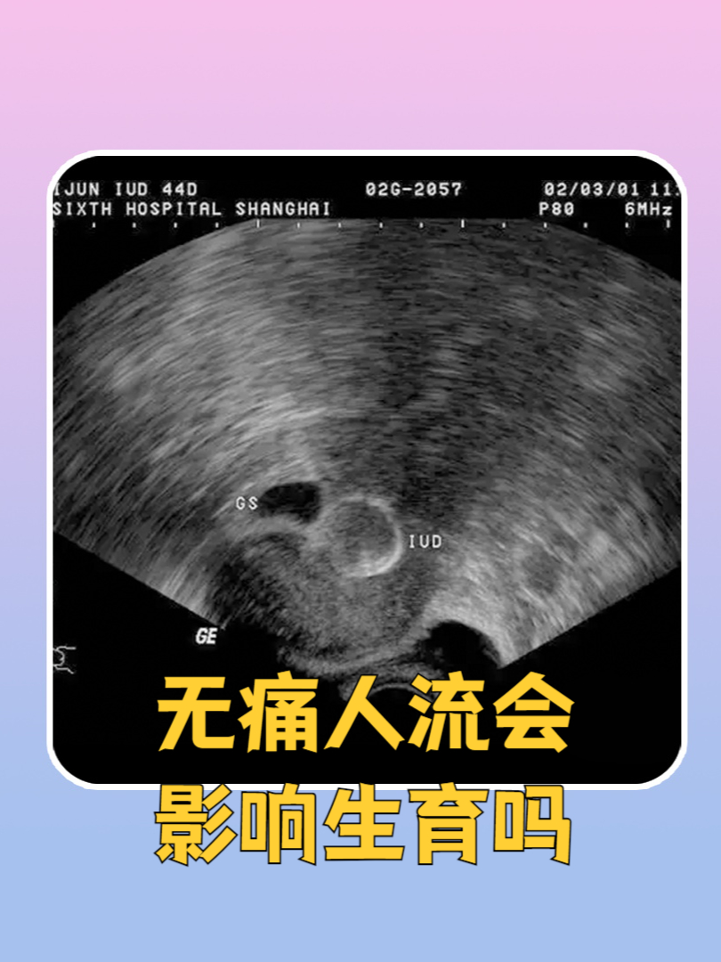 无痛人流是什么呢