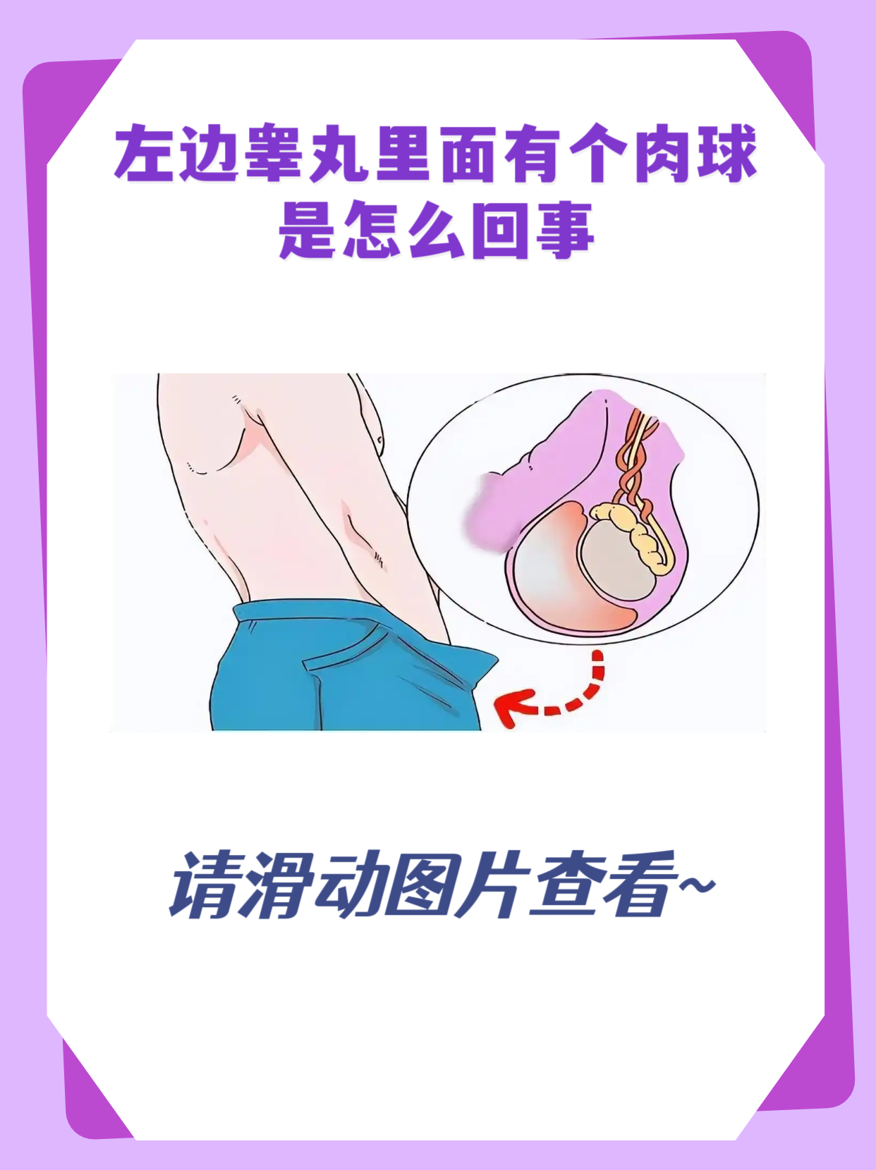 怎么治疗鞘膜积液