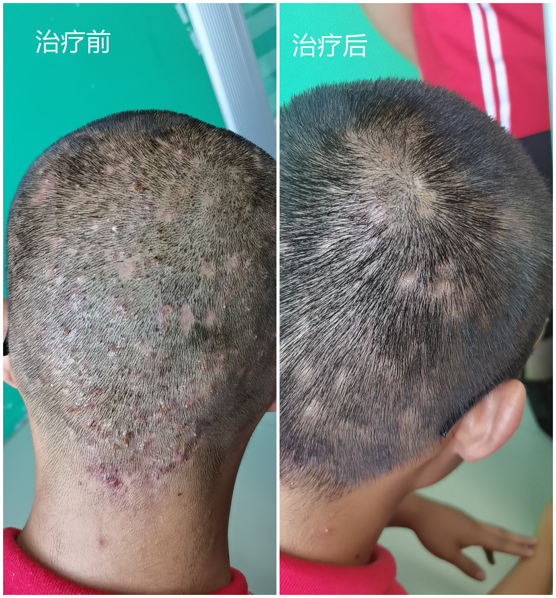 头上经常长小脓包怎么办