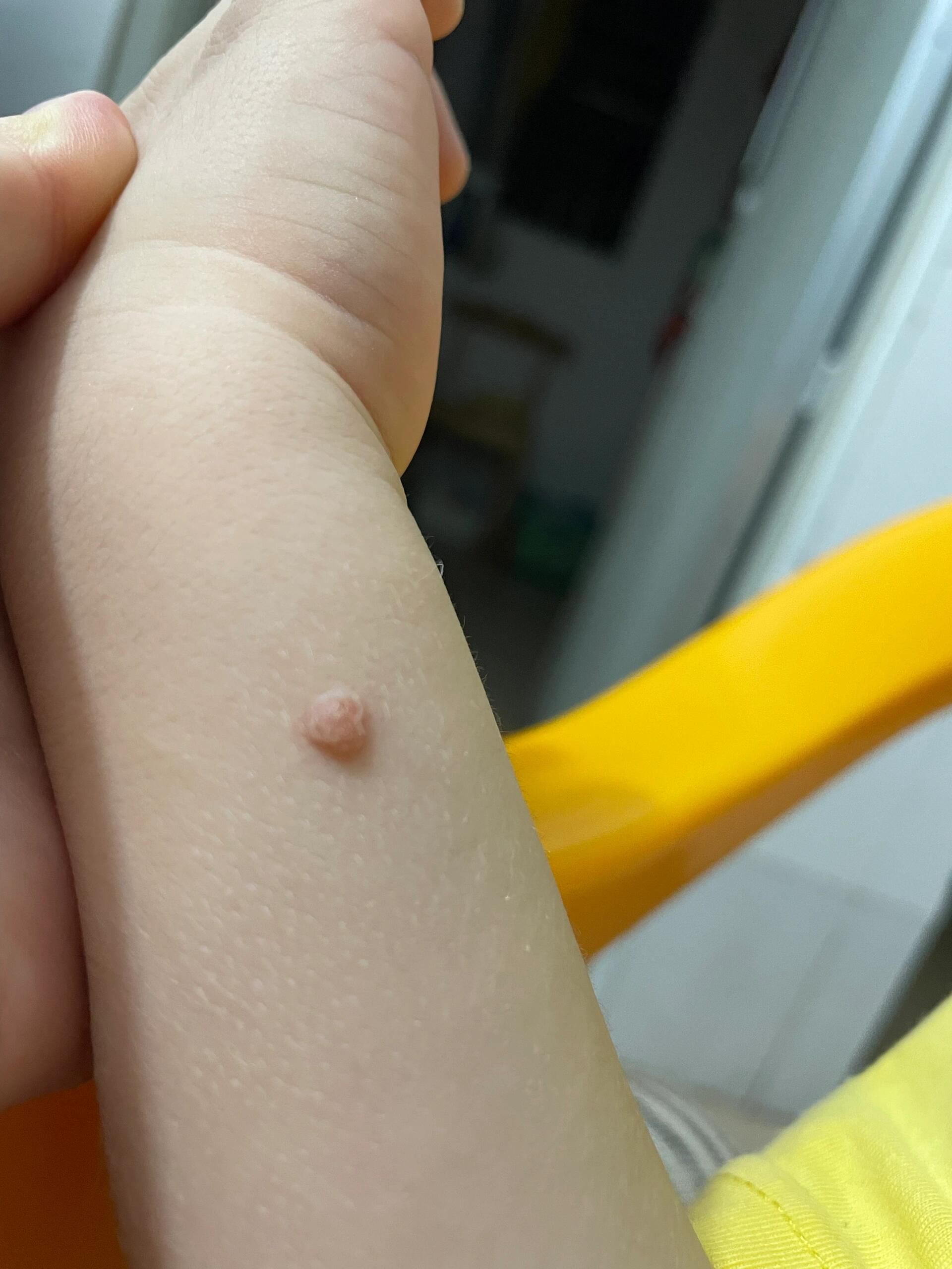 女性得了尖锐湿疣会怎么样?