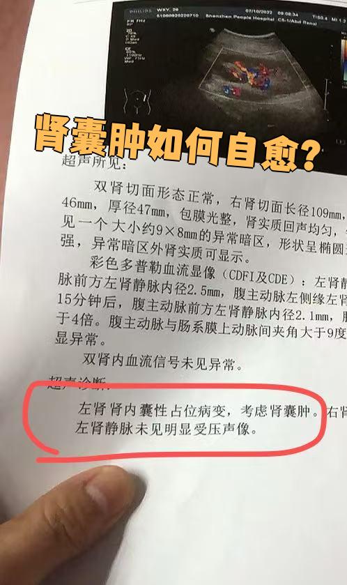 女性左肾囊肿能自愈吗