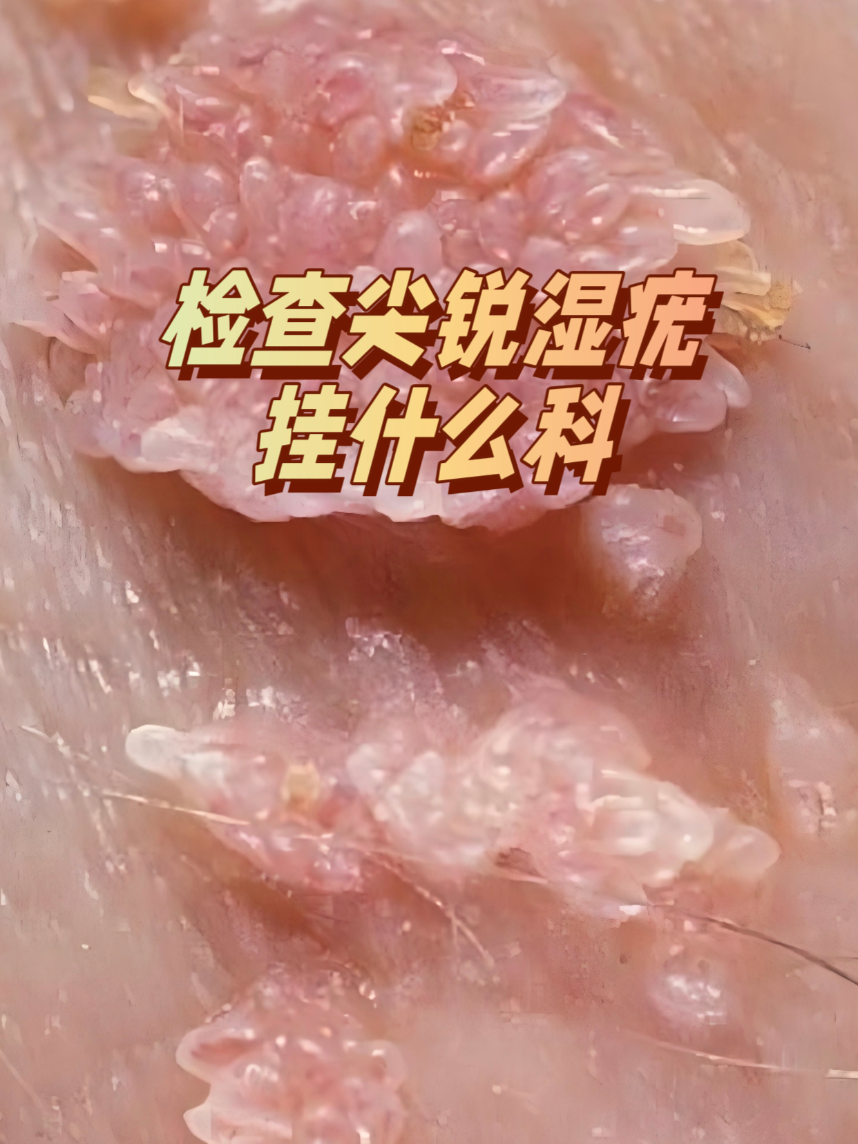 得尖锐湿疣的人多吗?