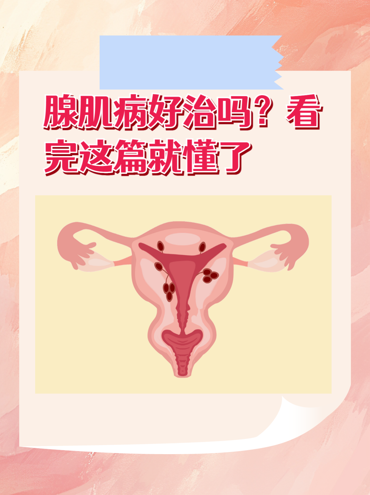 什么是子宫腺肌症?
