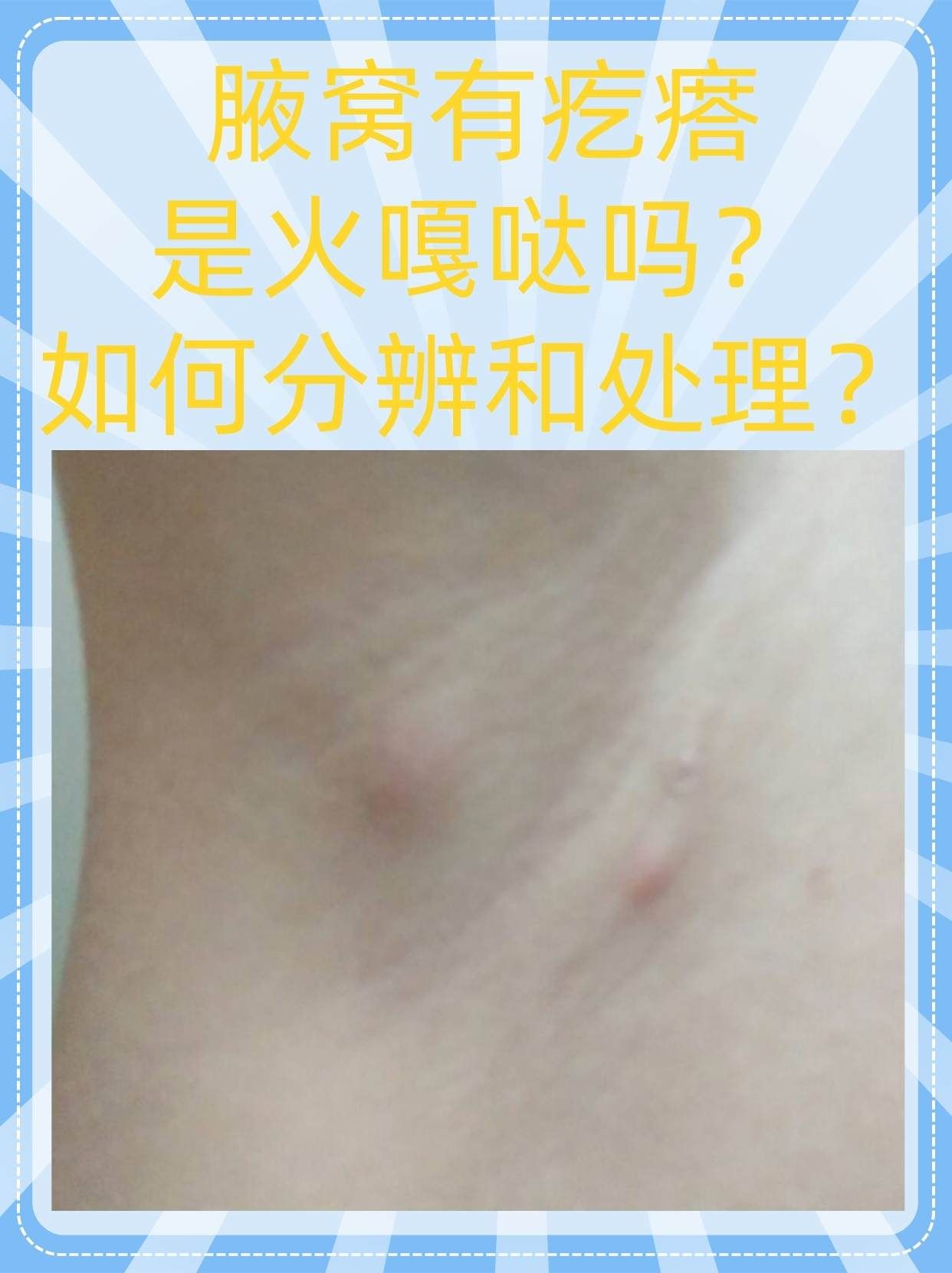 胳肢窝里面长小疙瘩怎么回事