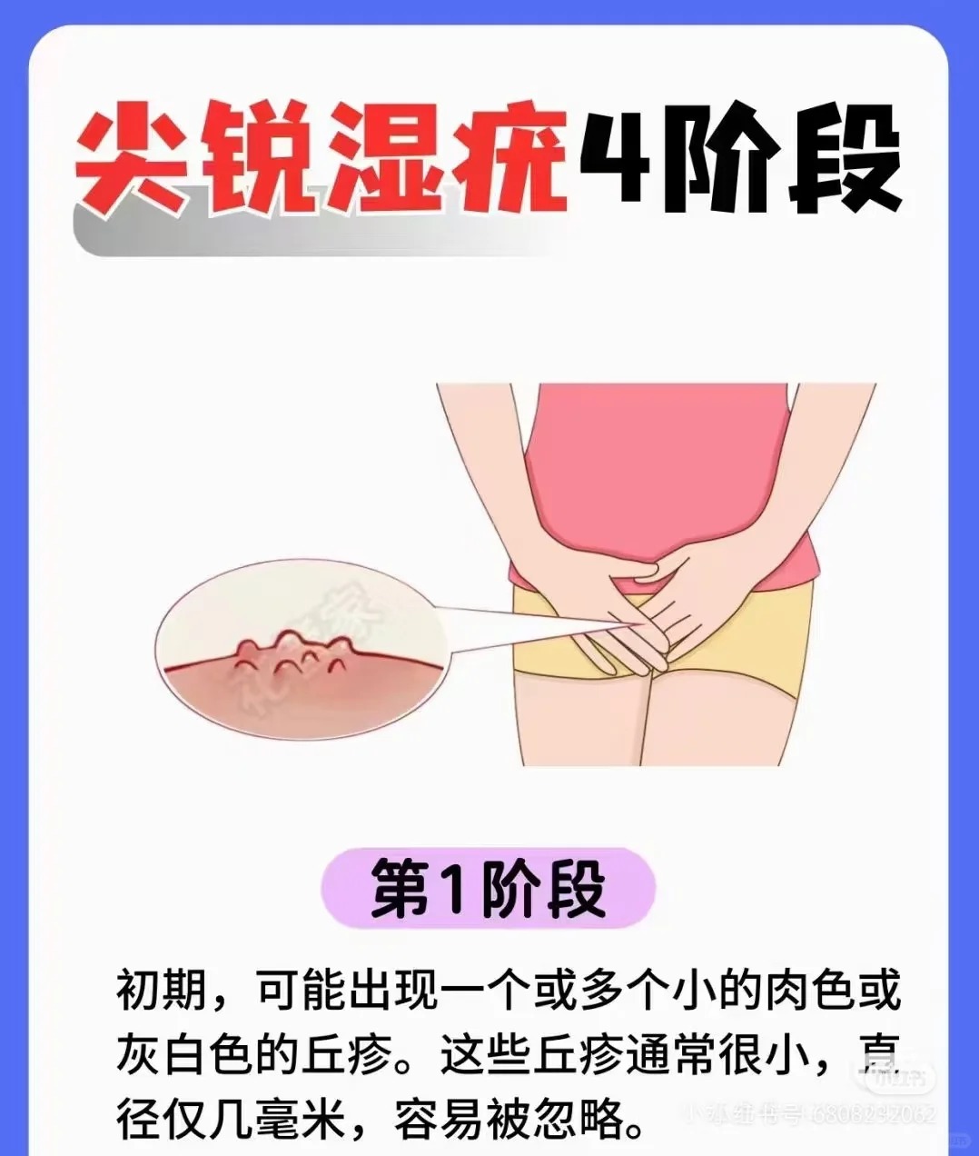 人为什么会得尖锐湿疣