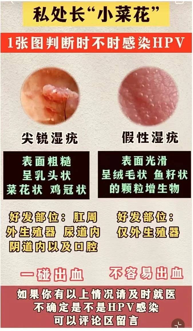 人为什么会得尖锐湿疣