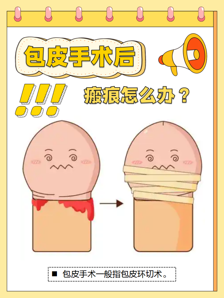 包皮粘连分离术