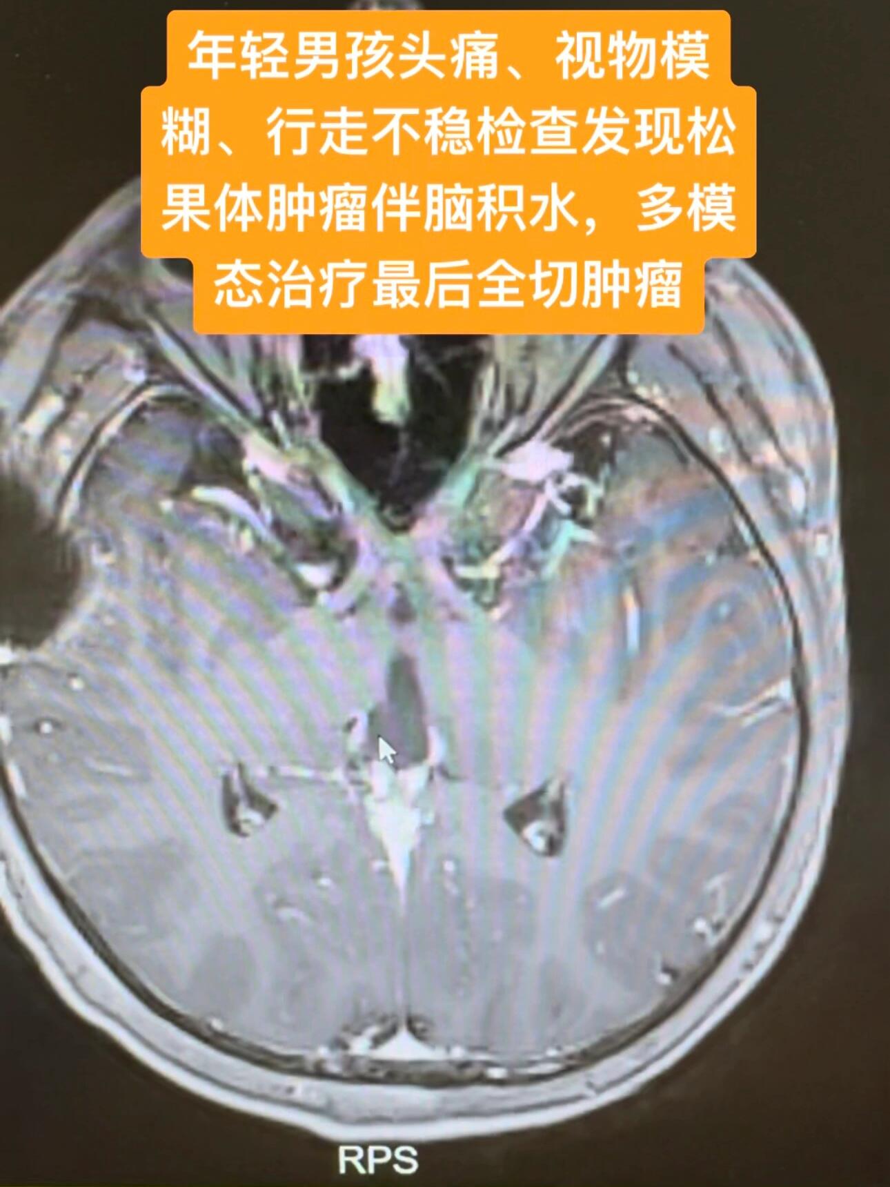 松果体囊肿,怎么办?