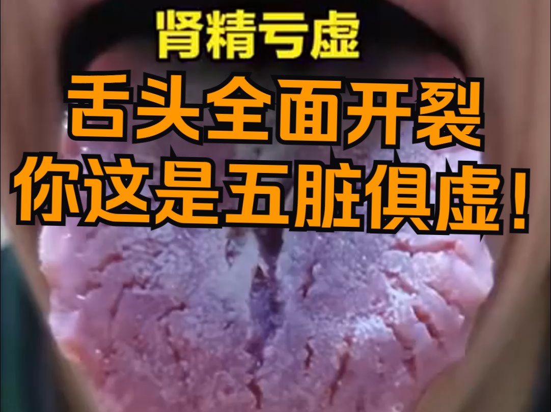 舌头裂开是什么原因而起的?