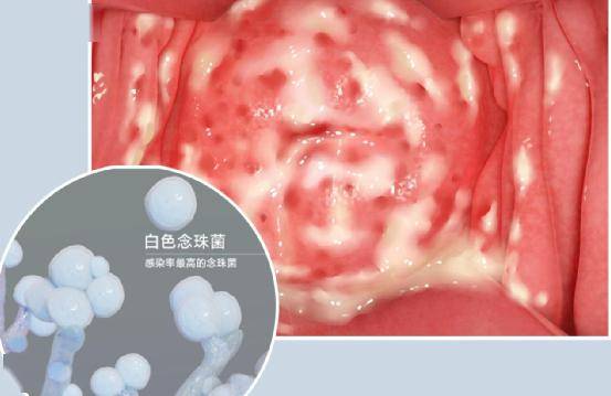 霉菌性阴道炎.是怎么引起的