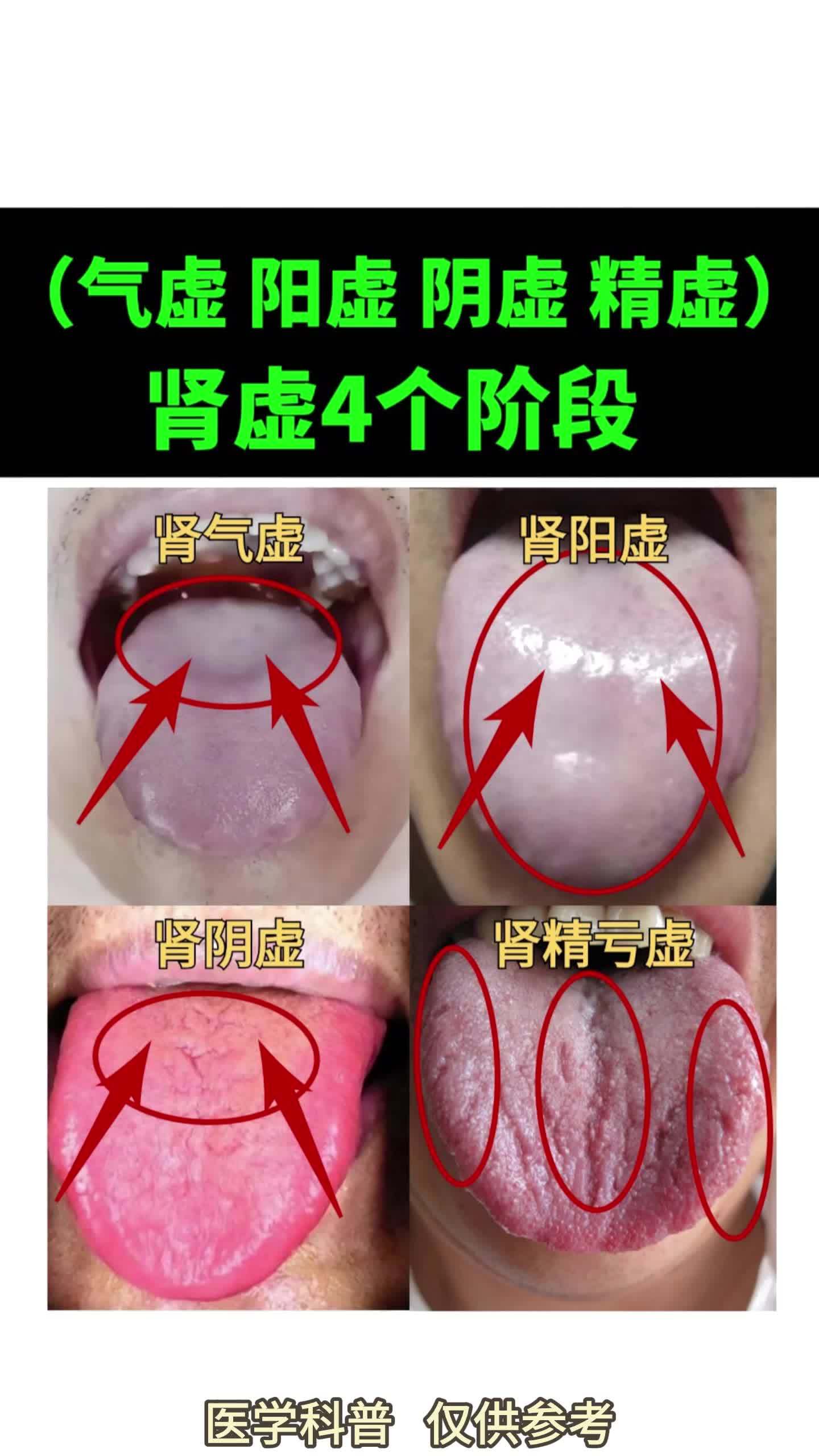 肾阴虚是什么症状