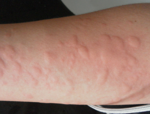 风疹传染吗?传染性强吗?