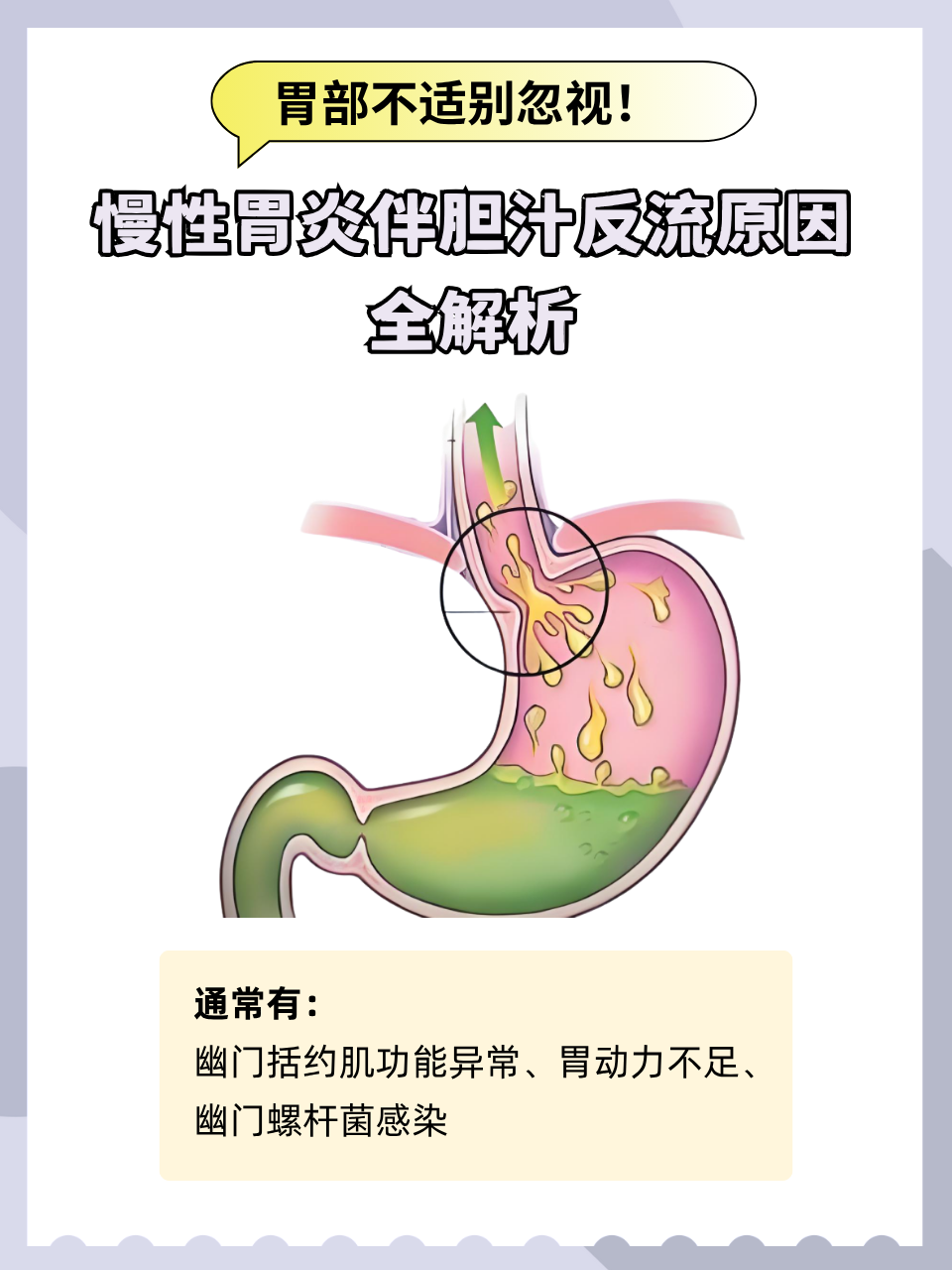 胆汁反流是什么原因引起的