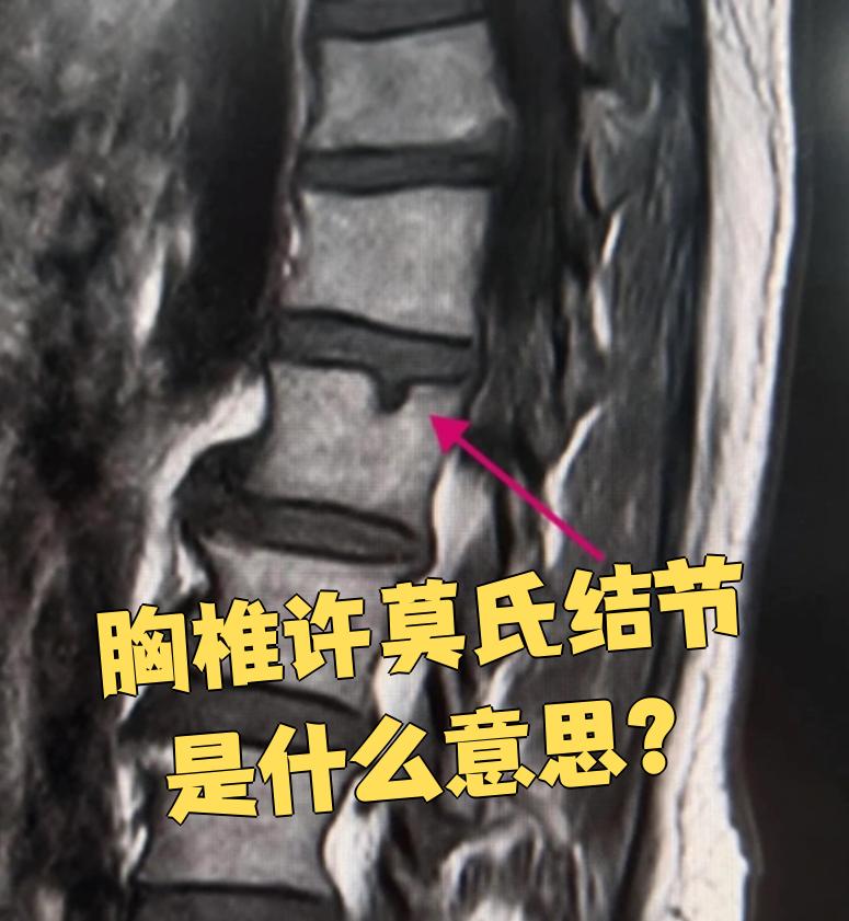 什么是许莫氏结节?..