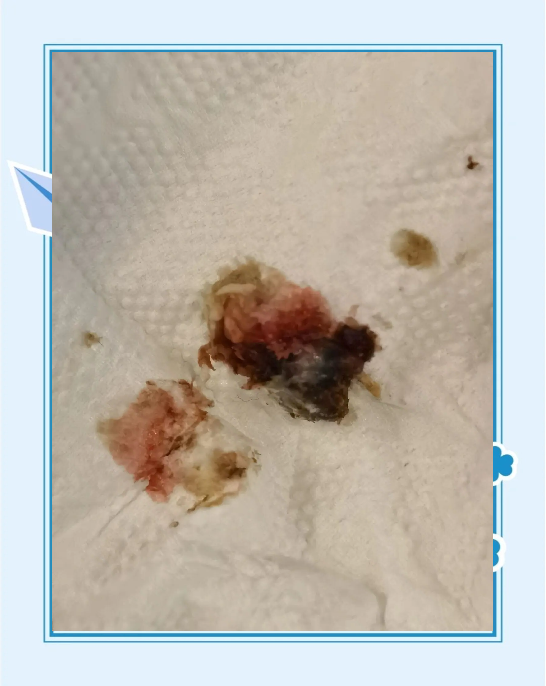 耳结石怎么取出来