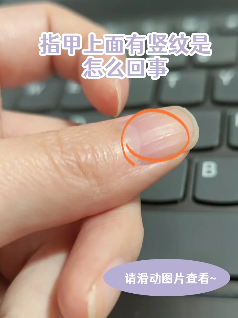 手指甲上有竖纹是怎么引起的