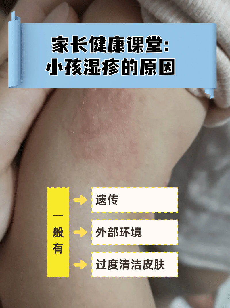 什么是过敏性湿疹?