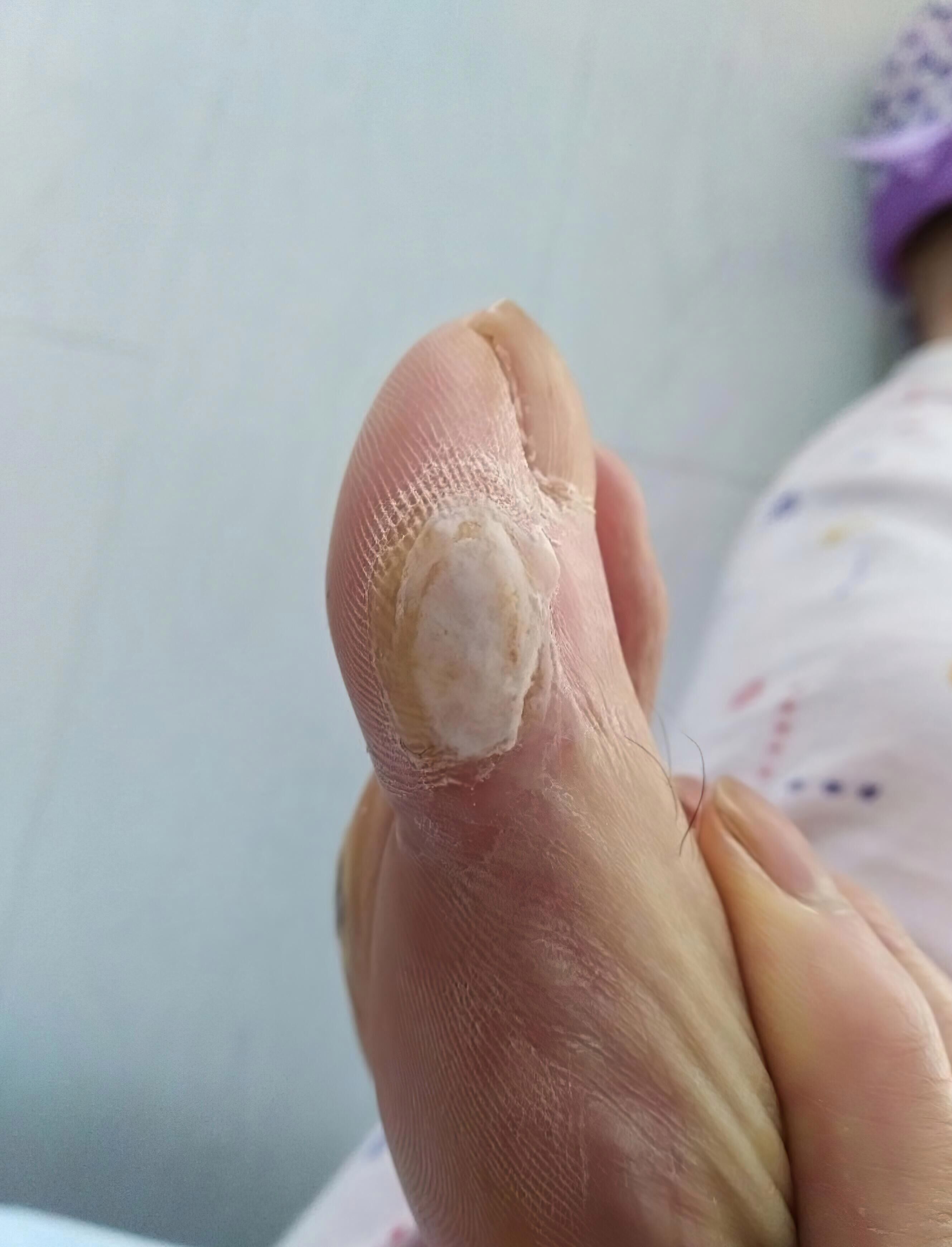 治疗脚鸡眼的小偏方?