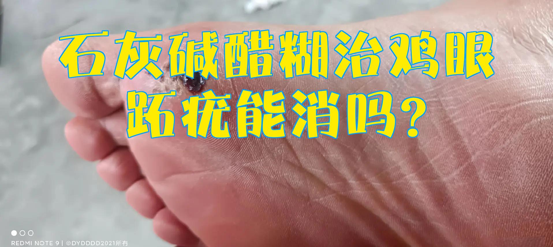 治疗脚鸡眼的小偏方?