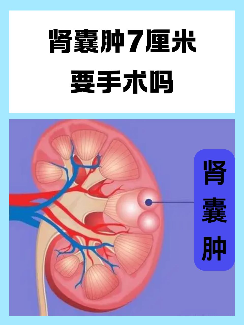 肾囊肿是怎样造成的
