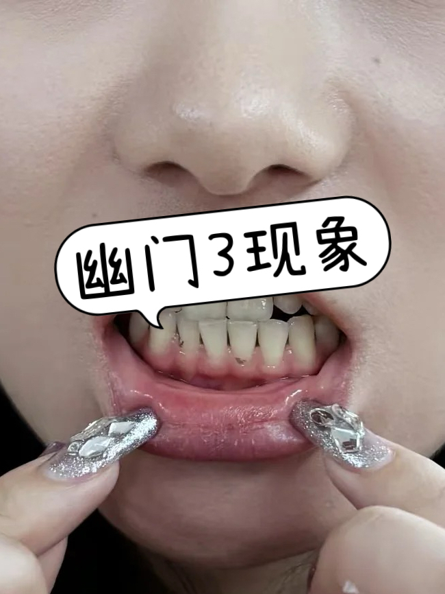 幽门螺杆菌口臭的表现有哪些