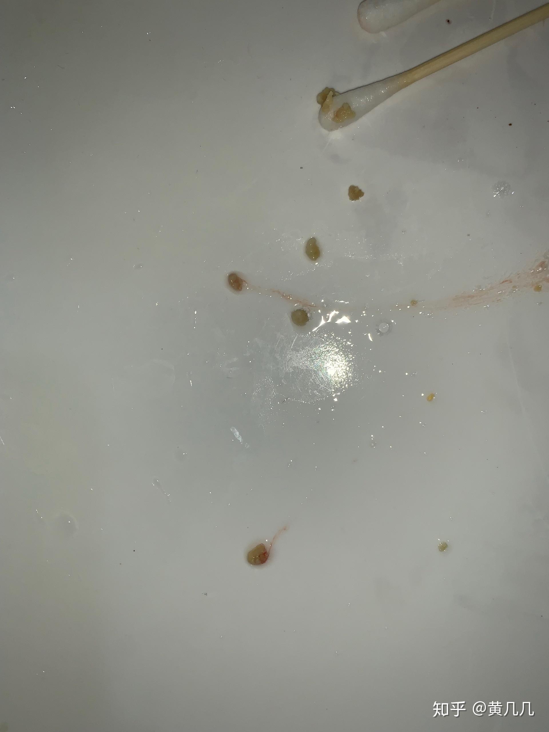 喉咙里有白色颗粒很臭