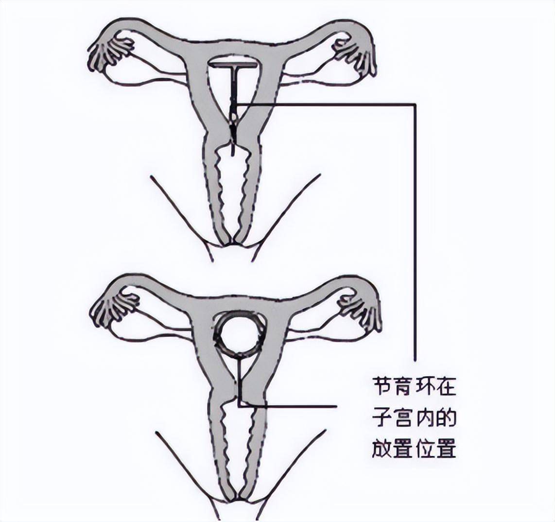 无痛取环麻醉打在哪里