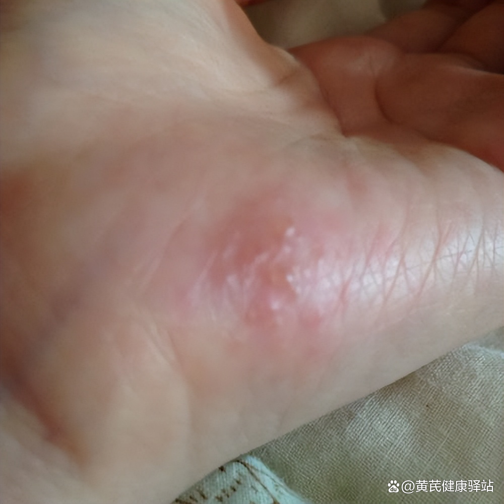 手上起小水泡是怎么回事?