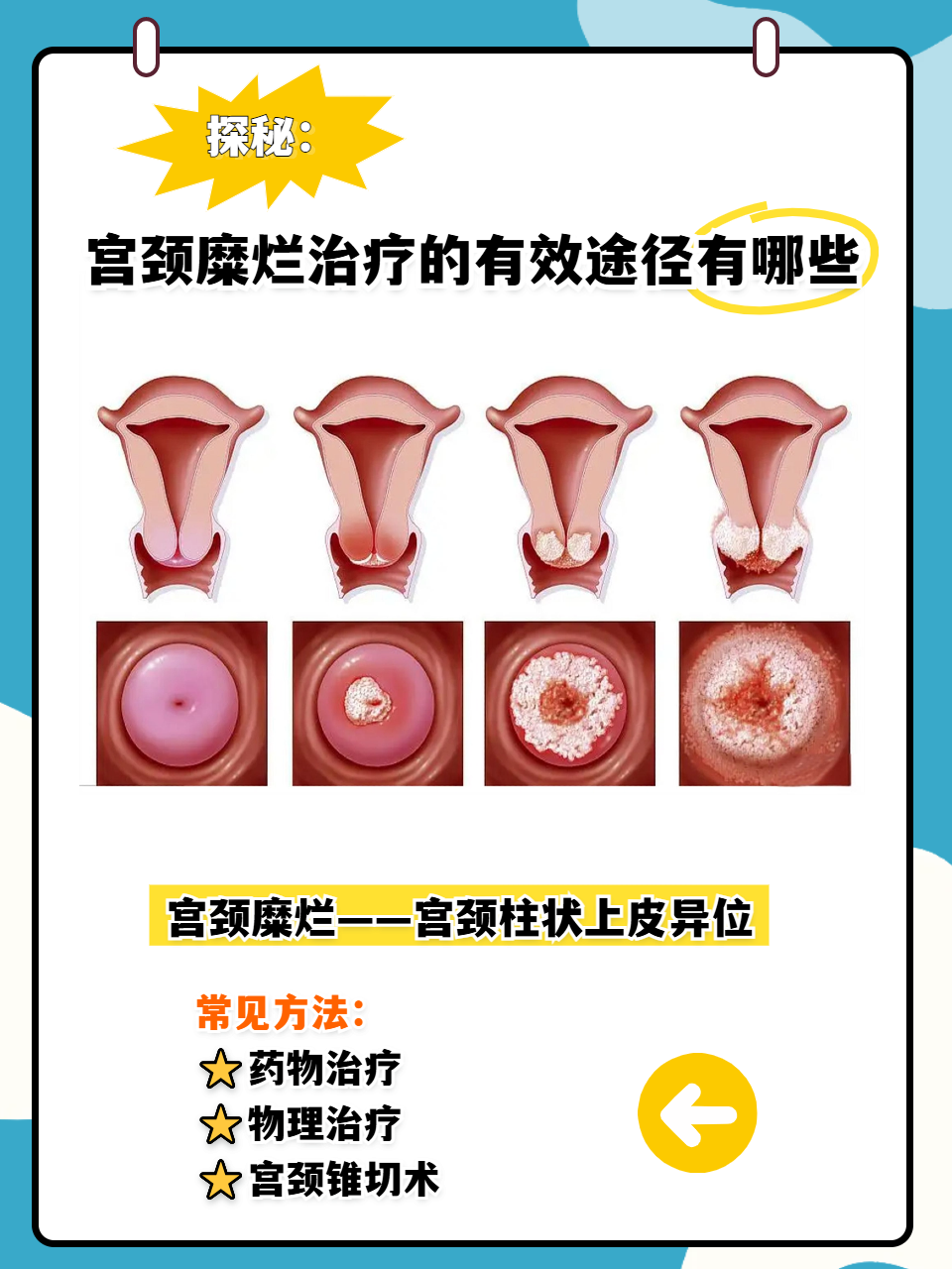 宫颈炎是怎么造成的