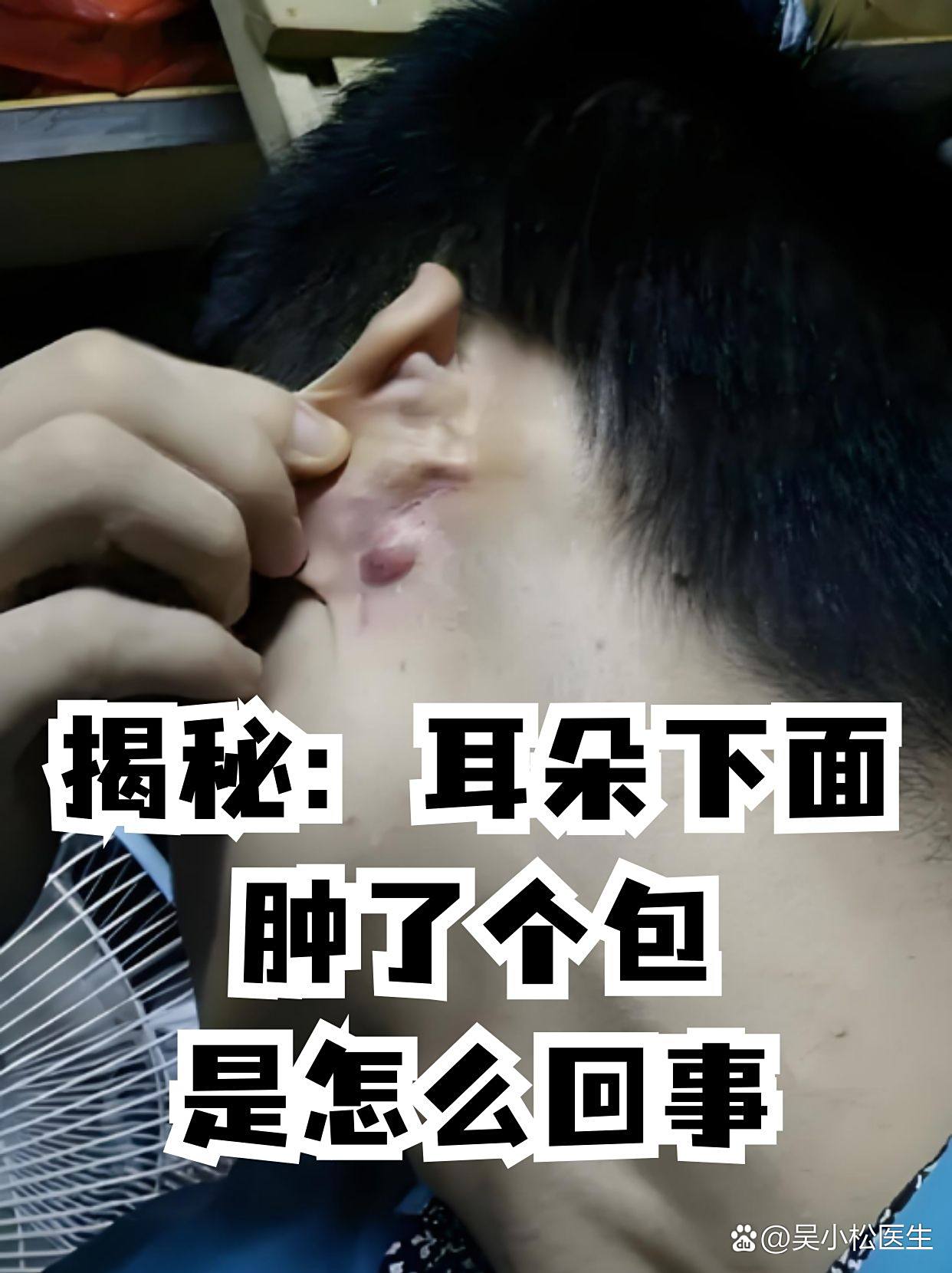 耳朵里面长了个疙瘩疼怎么回事