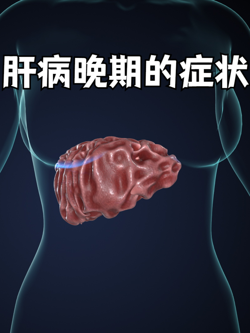 肝硬化晚期的症状有哪些