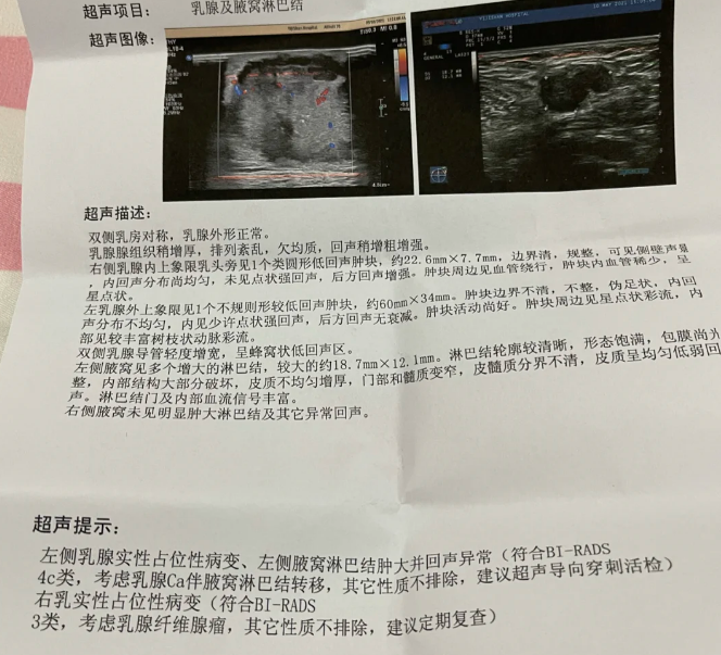 乳腺增生结节会癌变吗
