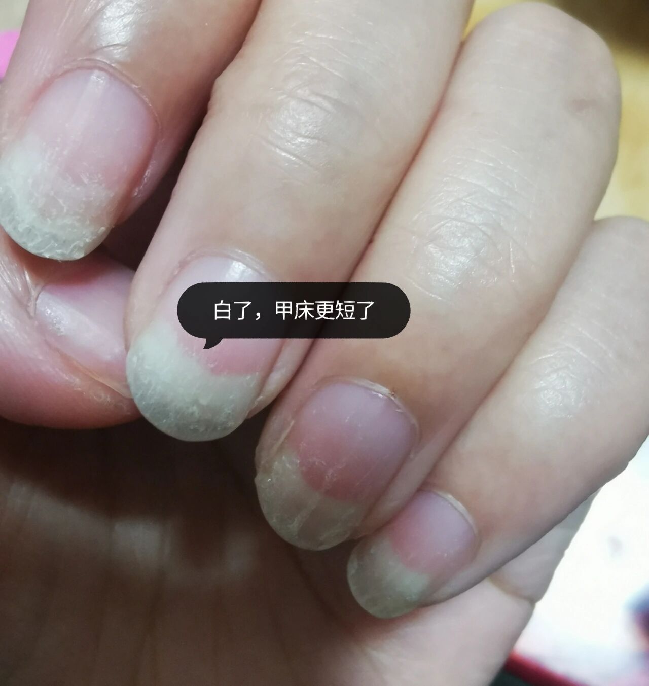 指甲一直发白是怎么回事