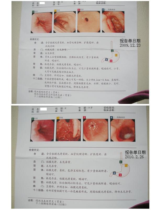 十二指肠球部溃疡严重吗