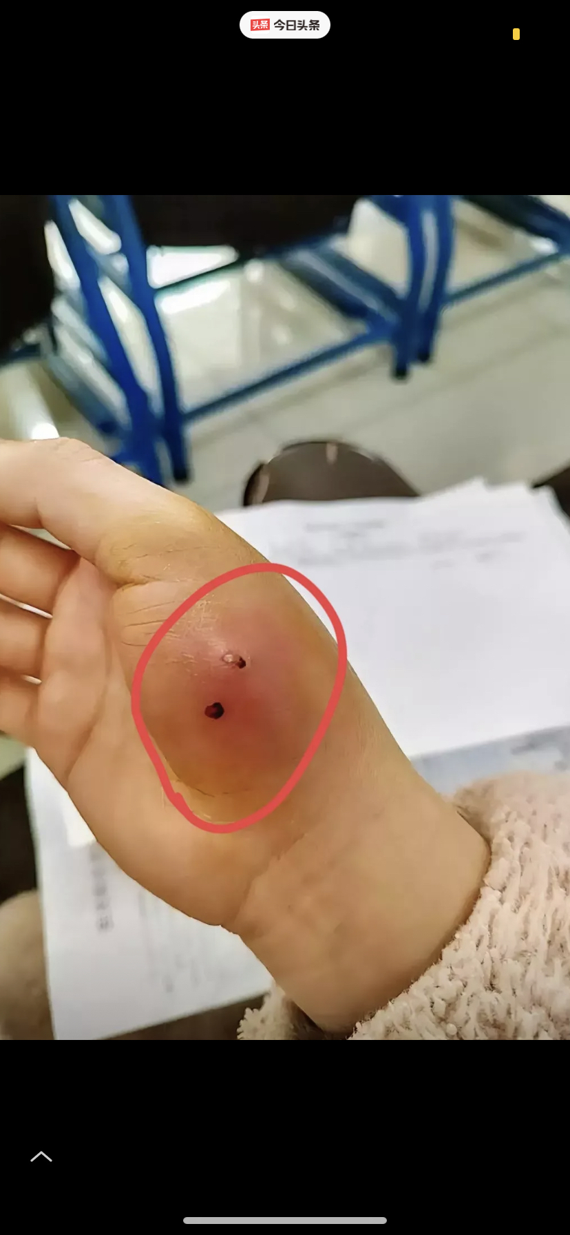 被猫咬到没出血鼓起来了,用打针吗.
