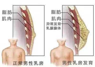 什么是男性乳腺发育症