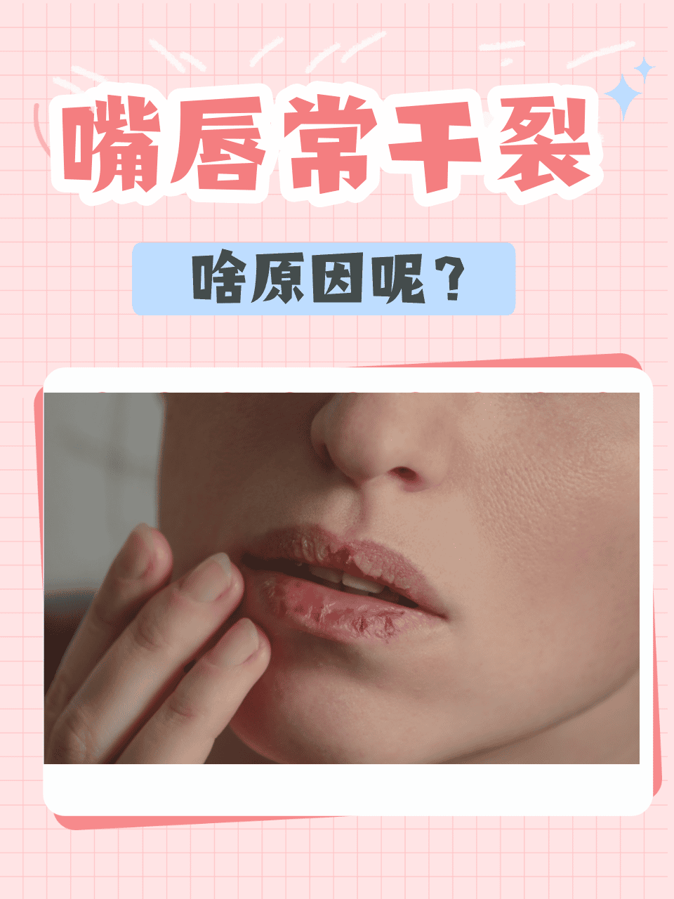 上嘴唇干裂是什么原因