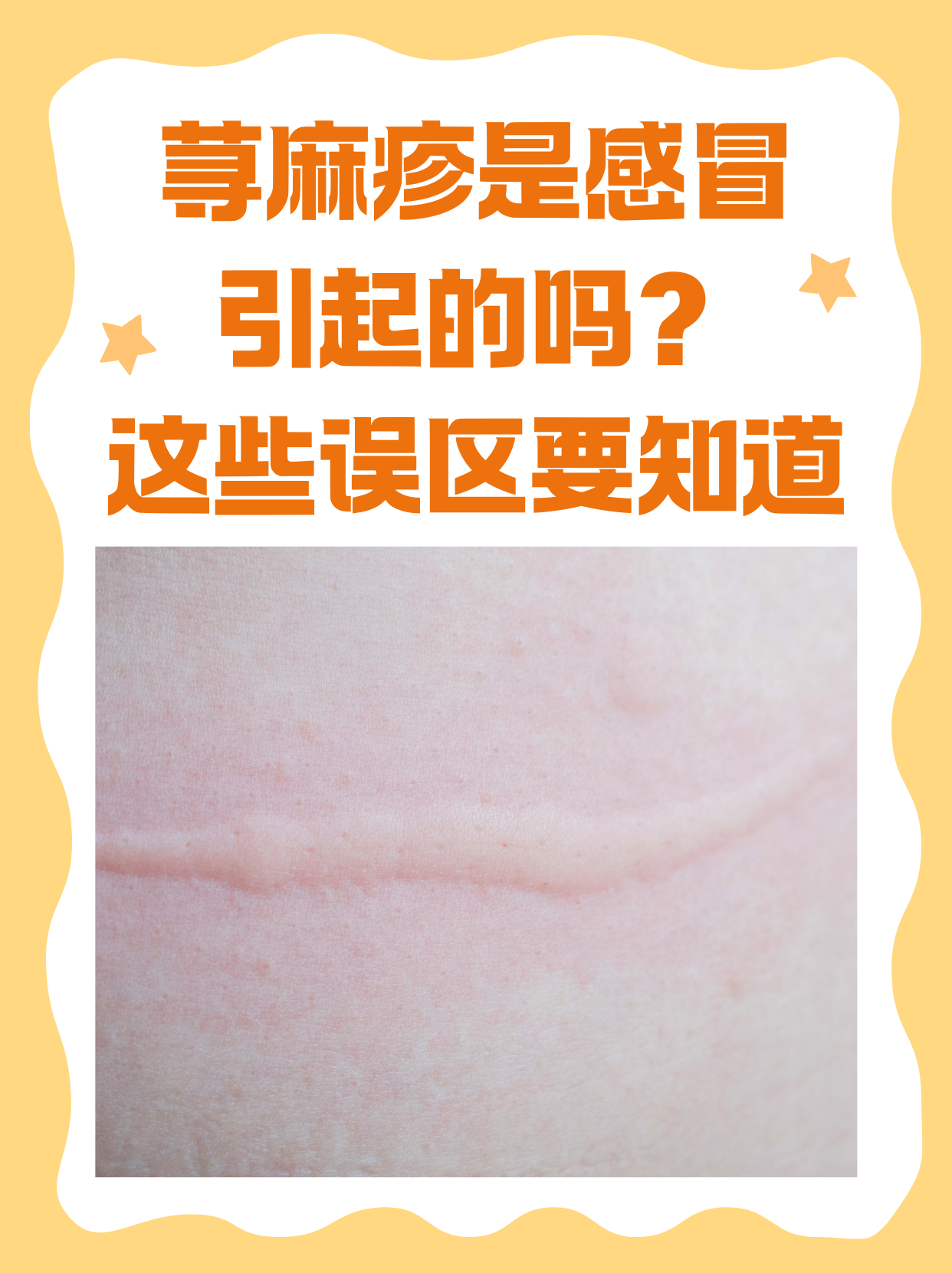 荨麻疹会不会传染?