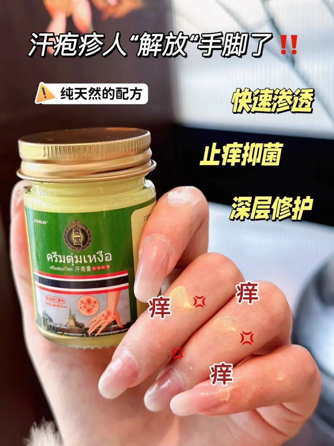 手上长汗疱疹怎么治疗