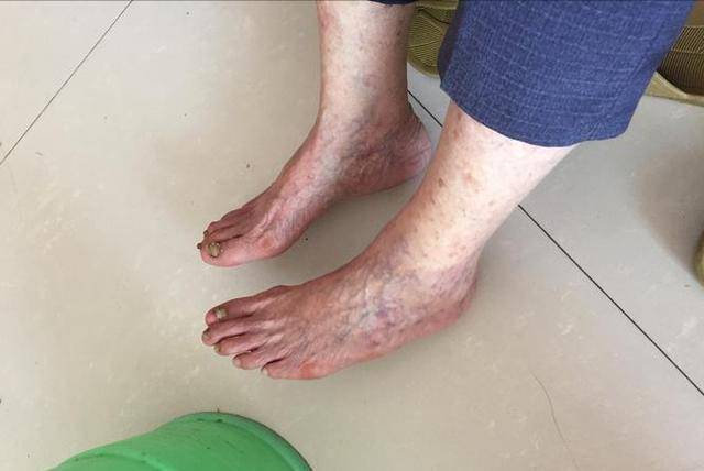 腿部血栓症状